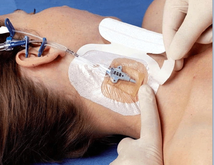 Master di I livello - Esperto gestione accessi vascolari